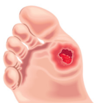 úlcera plantar