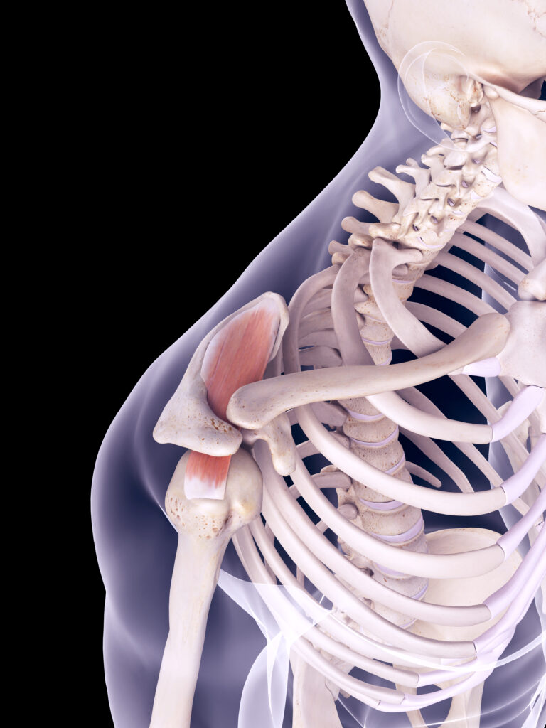 Ondas de choque para tratar la tendinitis del hombro: Ventajas sobre la fisioterapia