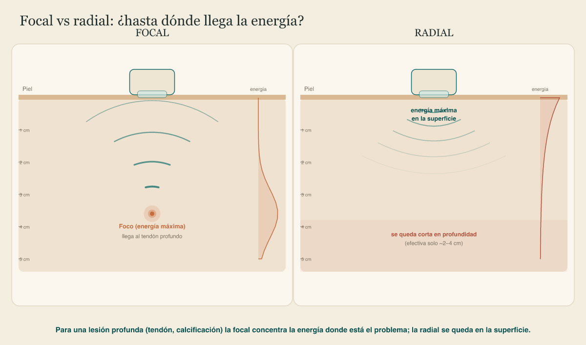 Comparativa de profundidad: la onda focal converge en un foco profundo; la radial se queda en la superficie